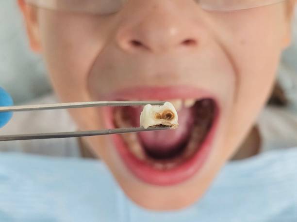 Best Emergency Tooth Extraction in Highland Park, MI